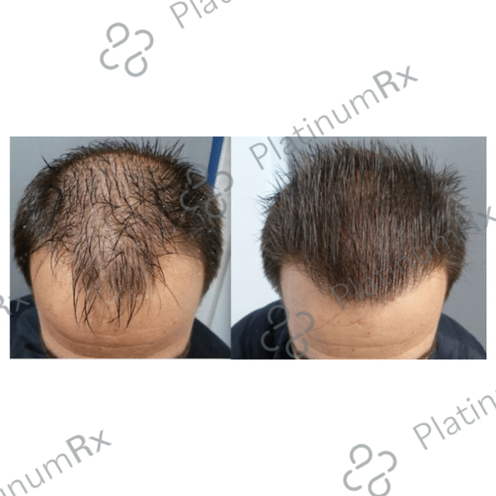 Tinfal Plus Solution 60ml