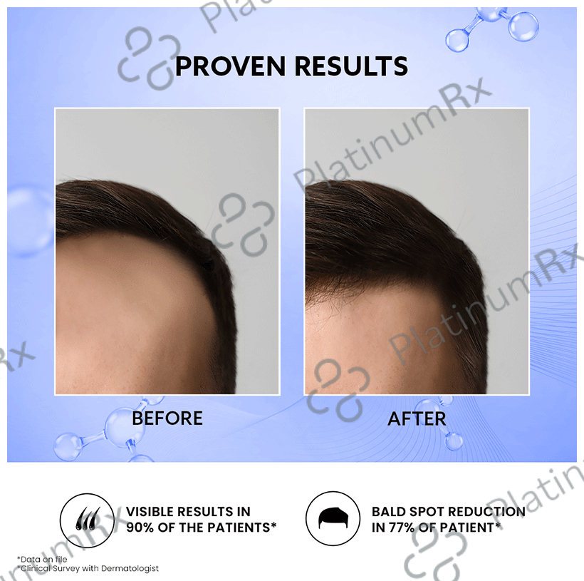 Mintop Forte 10% Hair Restore Formula 60ml